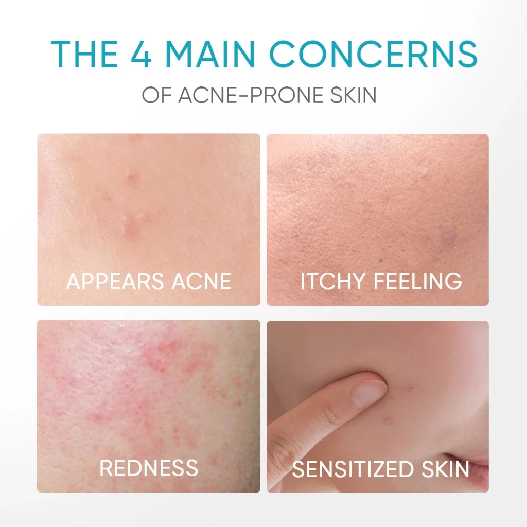 5% Panthenol Acne Calming Water Gel - Image 5