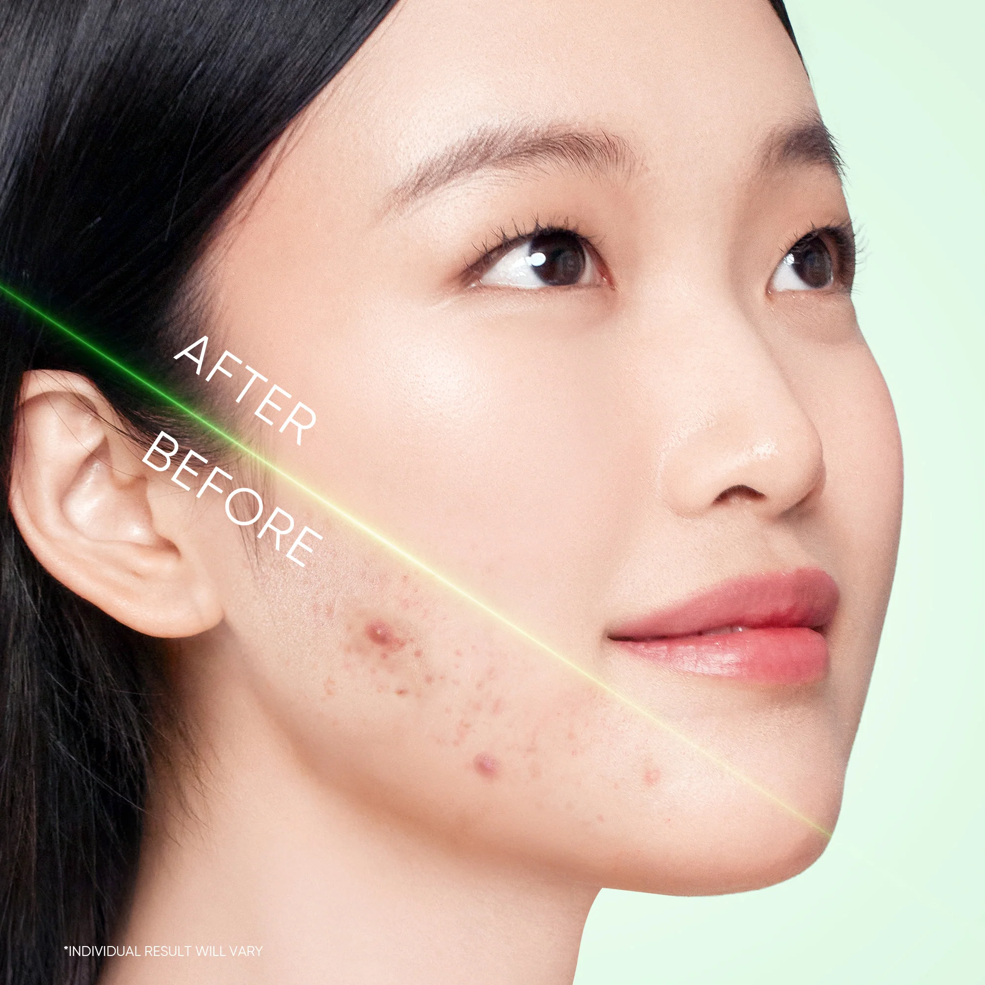 3X Acid Acne Gel Cleanser - Image 4